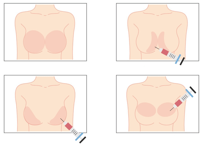 Mjesta za ubrizgavanje hijaluronske kiseline u dojke