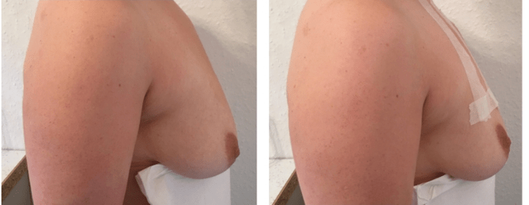 Prije i poslije podizanja grudi koncem