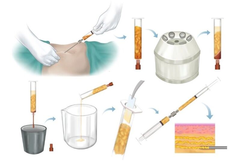 Uklanjanje masnoće s problematičnih područja, obrada i ubrizgavanje u tkivo dojke