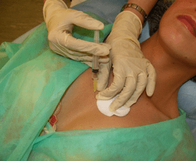 Uvođenje mezokoktela u tkivo dojke - alternativa injekcijama hijaluronske kiseline