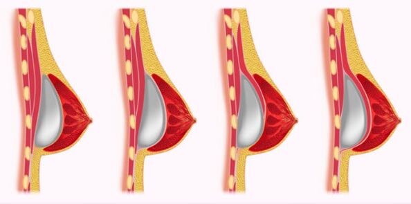metode ugradnje implantata za povećanje grudi